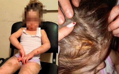 Bakıda ananın 4 yaşlı qızına verdiyi işgəncələr: Bədəni yandırılıb, kəmərlə döyülüb - TƏFƏRRÜAT